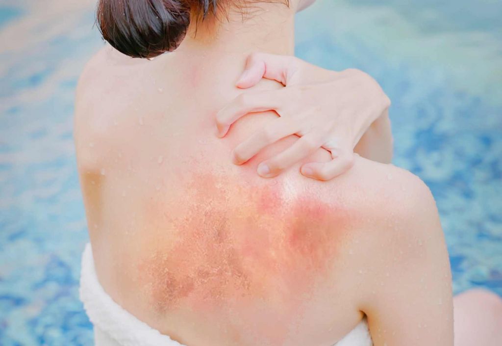 Comment distinguer les coups de soleil et la réaction allergique ?