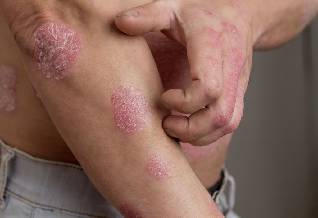Comment les produits Druide peuvent aider à soulager le psoriasis ?