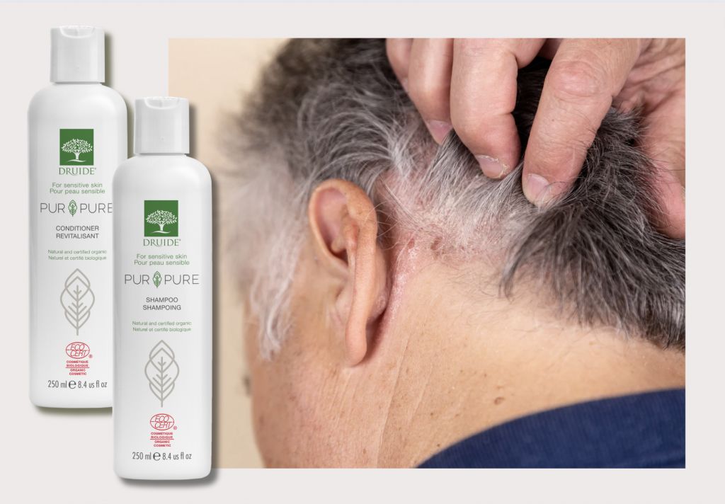 Comment soulager l'eczéma capillaire : remèdes naturels et produits bio